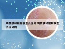 鸡皮肤和银屑病怎么区分 鸡皮肤和银屑病怎么区分的