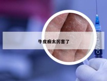 牛皮癣太厉害了