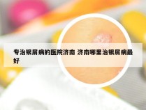专治银屑病的医院济南 济南哪里治银屑病最好