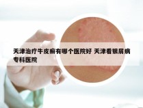 天津治疗牛皮癣有哪个医院好 天津看银屑病专科医院