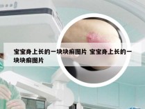 宝宝身上长的一块块癣图片 宝宝身上长的一块块癣图片
