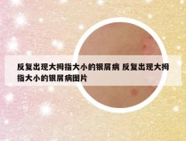 反复出现大拇指大小的银屑病 反复出现大拇指大小的银屑病图片