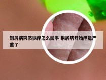 银屑病突然很痒怎么回事 银屑病开始痒是严重了