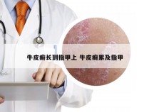 牛皮癣长到指甲上 牛皮癣累及指甲