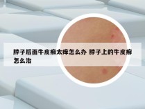 脖子后面牛皮癣太痒怎么办 脖子上的牛皮癣怎么治