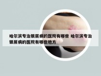 哈尔滨专治银屑病的医院有哪些 哈尔滨专治银屑病的医院有哪些地方