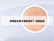 皮癣起皮是不是就快好了 皮藓起皮