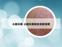 小腿长藓 小腿长藓蜕皮皮肤变硬