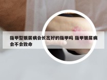 指甲型银屑病会长出好的指甲吗 指甲银屑病会不会致命