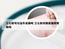 三七粉可以治牛皮癣吗 三七粉对银屑病有帮助吗