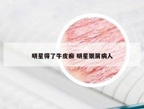 明星得了牛皮癣 明星银屑病人
