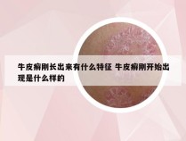 牛皮癣刚长出来有什么特征 牛皮癣刚开始出现是什么样的