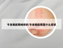 牛皮癣前期啥样的 牛皮癣前期是什么症状