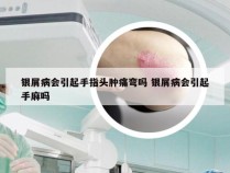 银屑病会引起手指头肿痛弯吗 银屑病会引起手麻吗