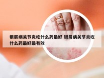 银屑病关节炎吃什么药最好 银屑病关节炎吃什么药最好最有效