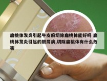 扁桃体发炎引起牛皮癣切除扁桃体能好吗 扁桃体发炎引起的银屑病,切除扁桃体有什么危害