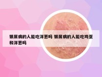 银屑病的人能吃洋葱吗 银屑病的人能吃鸡蛋和洋葱吗