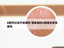 B族可以治牛皮癣吗 银屑病吃b族维生素有用吗