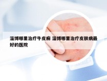 淄博哪里治疗牛皮癣 淄博哪里治疗皮肤病最好的医院