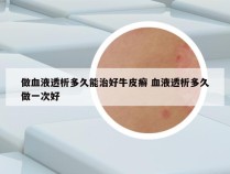 做血液透析多久能治好牛皮癣 血液透析多久做一次好