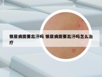 银屑病需要出汗吗 银屑病需要出汗吗怎么治疗