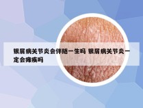 银屑病关节炎会伴随一生吗 银屑病关节炎一定会瘫痪吗