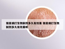 银屑病打生物制剂多久有效果 银屑病打生物制剂多久有效果呢