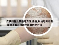 皮肤颜色比其他地方深,像癣,别的地方也有 皮肤上有几块颜色比其他地方深