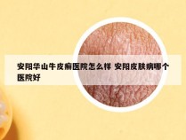 安阳华山牛皮癣医院怎么样 安阳皮肤病哪个医院好
