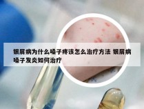 银屑病为什么嗓子疼该怎么治疗方法 银屑病嗓子发炎如何治疗