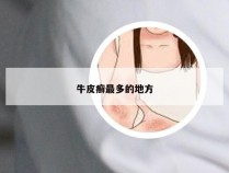 牛皮癣最多的地方
