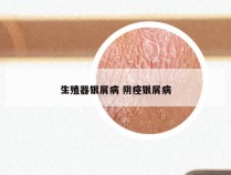 生殖器银屑病 阴痉银屑病