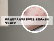 银屑病关节炎关节损害不可逆 银屑病关节炎可以活多久