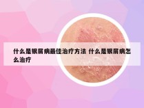 什么是银屑病最佳治疗方法 什么是银屑病怎么治疗