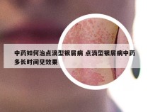 中药如何治点滴型银屑病 点滴型银屑病中药多长时间见效果