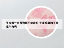 牛皮癣一点发物都不能吃吗 牛皮癣真的不能吃牛肉吗