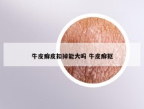 牛皮癣皮扣掉能大吗 牛皮癣抠