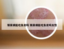 银屑病能吃鱼皮吗 银屑病能吃鱼皮吗女性