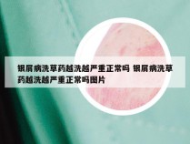 银屑病洗草药越洗越严重正常吗 银屑病洗草药越洗越严重正常吗图片