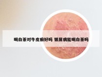 喝白茶对牛皮癣好吗 银屑病能喝白茶吗