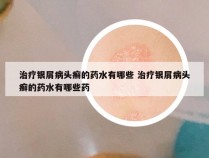 治疗银屑病头癣的药水有哪些 治疗银屑病头癣的药水有哪些药