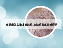 皮肤癣怎么治才能除根 皮肤癣怎么治好得快