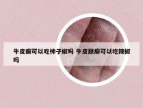 牛皮癣可以吃柿子椒吗 牛皮肤癣可以吃辣椒吗