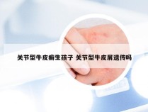 关节型牛皮癣生孩子 关节型牛皮屑遗传吗