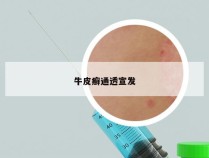 牛皮癣通透宣发