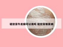 硫软膏牛皮癣可以用吗 硫软膏银屑病