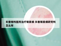 长春哪所医院治疗银屑病 长春银屑病研究所怎么样