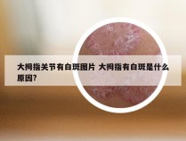 大拇指关节有白斑图片 大拇指有白斑是什么原因?