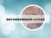 最新牛皮癣银屑病能根治吗 2021牛皮癣