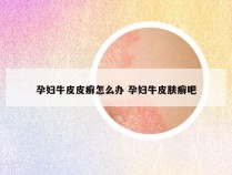 孕妇牛皮皮癣怎么办 孕妇牛皮肤癣吧